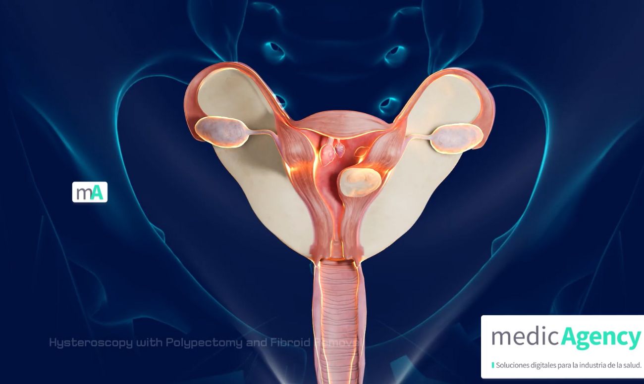 Histeroscopia con polipectomía y extirpación de miomas - Vídeos educativos